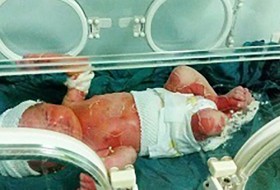آخرین وضعیت پرونده سوختگی نوزاد سه روزه/ پرونده به کمیسیون تخصصی ارسال شد