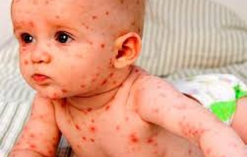 سرخک در کمین کودکان واکسن نزده است